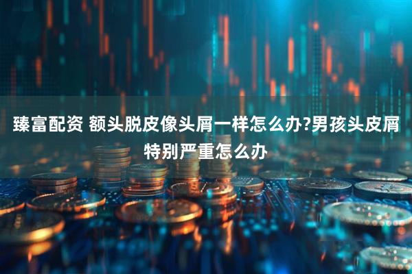 臻富配资 额头脱皮像头屑一样怎么办?男孩头皮屑特别严重怎么办
